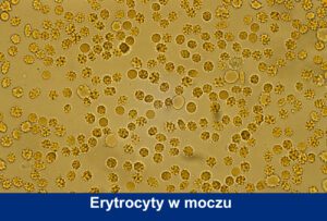 Erytrocyty w moczu (krwiomocz i krwinkomocz) – co oznaczają i jak je leczyć?