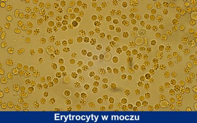 Erytrocyty w moczu: co oznaczają i jak leczyć?