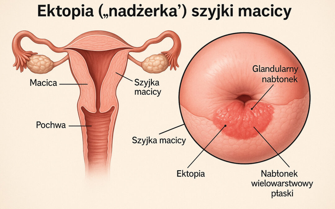 Ektopia („nadżerka") szyjki macicy - objawy, przyczyny i leczenie